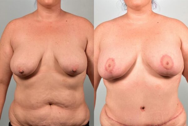 Breast Augmentation 125