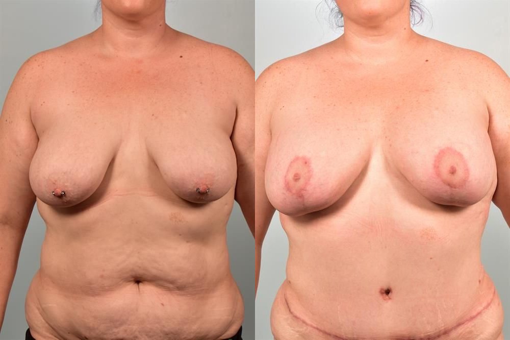 Breast Augmentation 125