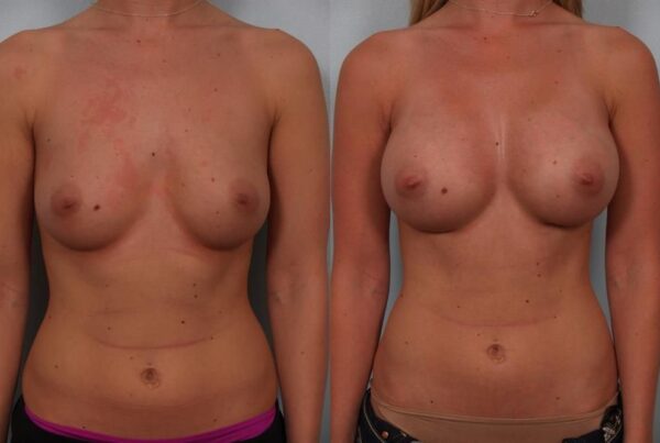 Breast Augmentation 126