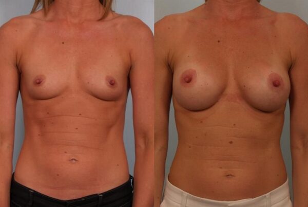 Breast Augmentation 127