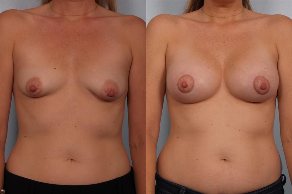 Breast Augmentation 128