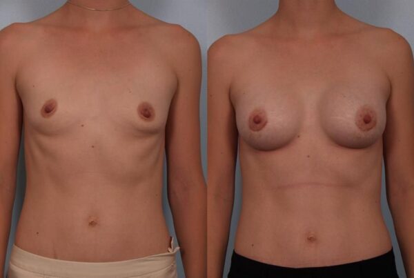 Breast Augmentation 129
