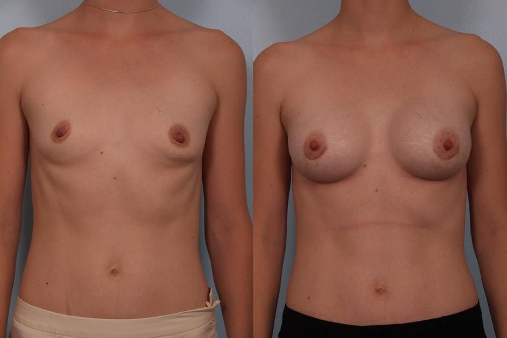 Breast Augmentation 129