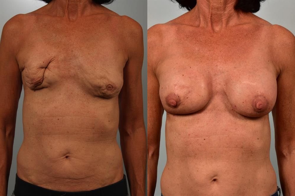 Breast Augmentation 13