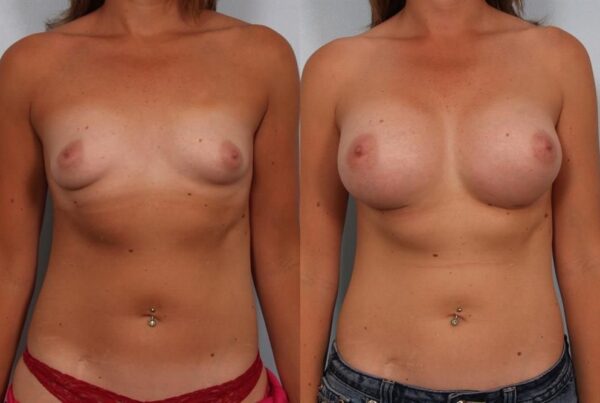 Breast Augmentation 130