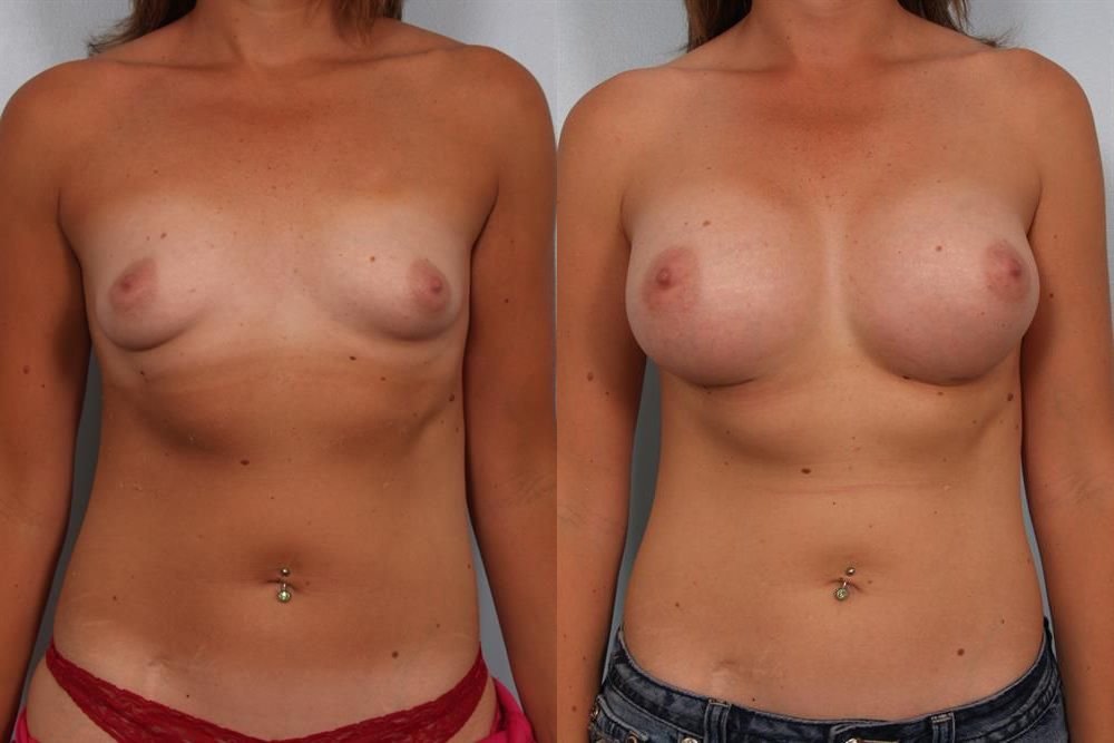 Breast Augmentation 130