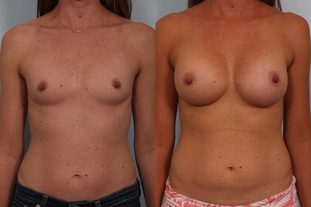 Breast Augmentation 131