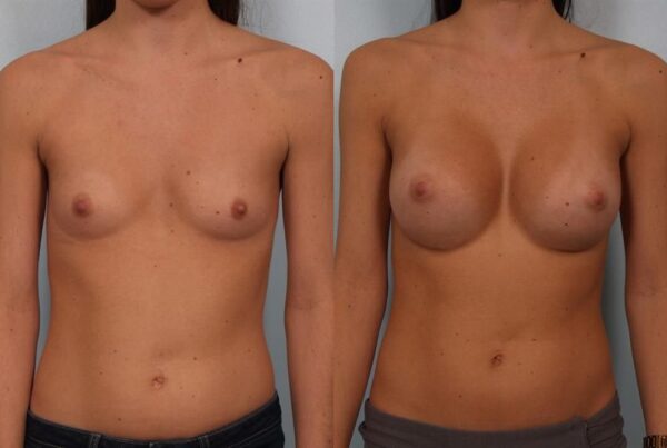 Breast Augmentation 132