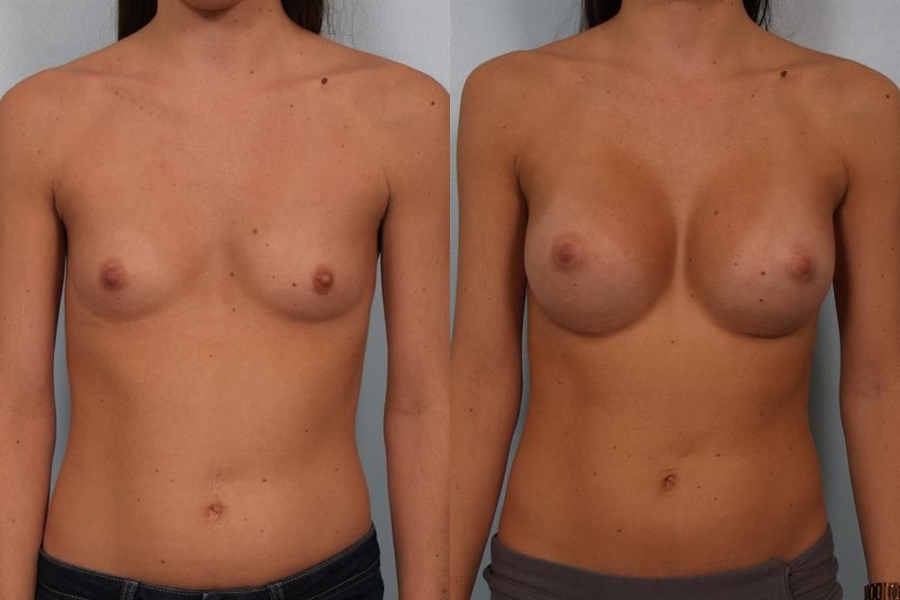 Breast Augmentation 132