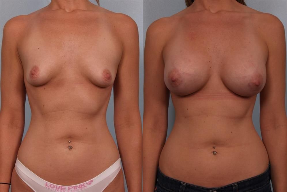 Breast Augmentation 133