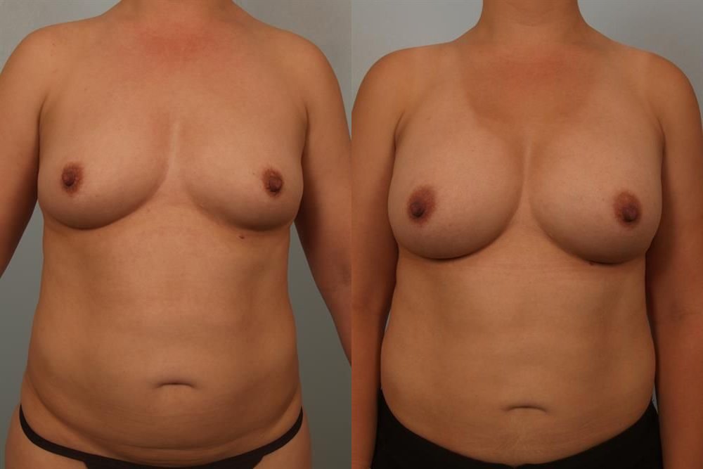 Breast Augmentation 134