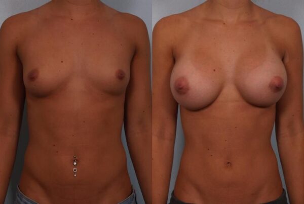 Breast Augmentation 135