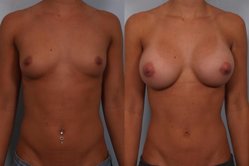 Breast Augmentation 135
