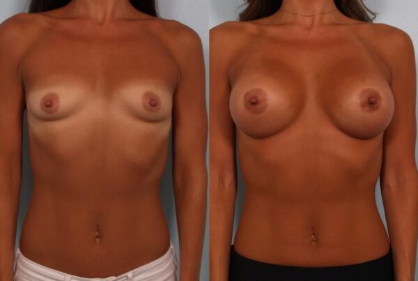 Breast Augmentation 136