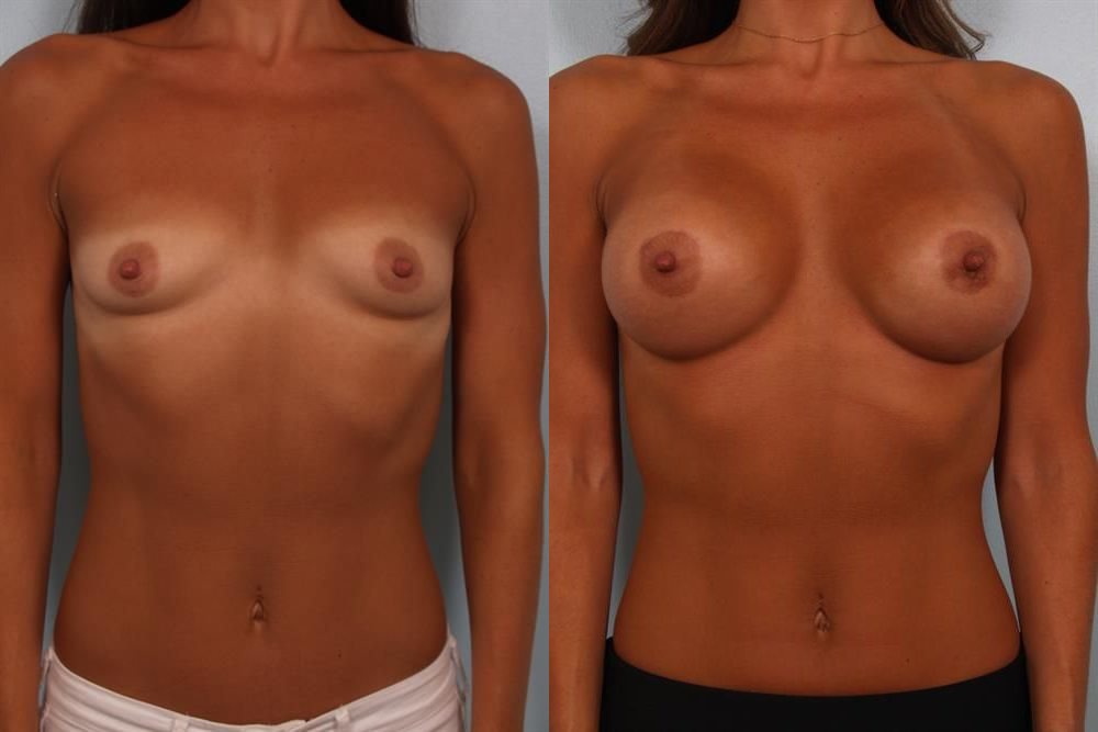 Breast Augmentation 136