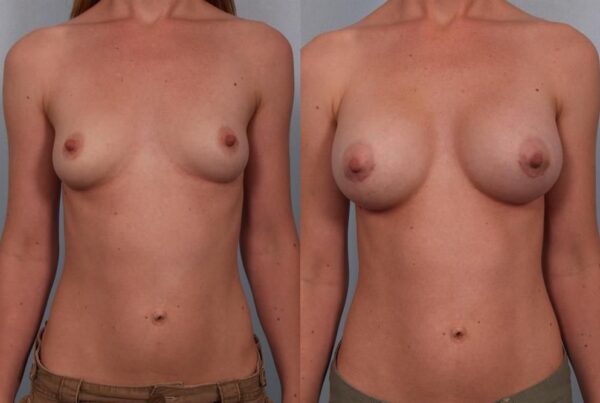 Breast Augmentation 137