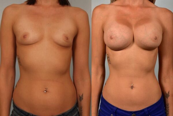 Breast Augmentation 138