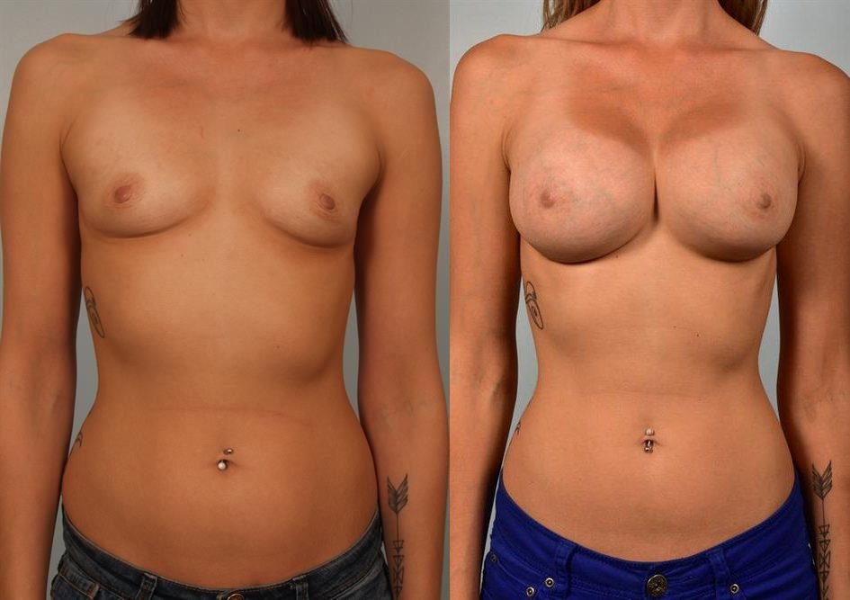 Breast Augmentation 138