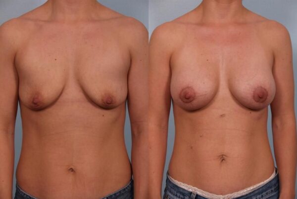Breast Augmentation 139