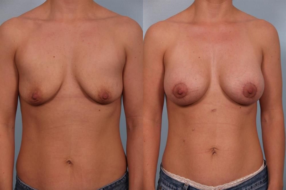 Breast Augmentation 139