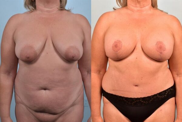 Breast Augmentation 14