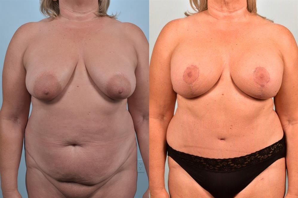 Breast Augmentation 14