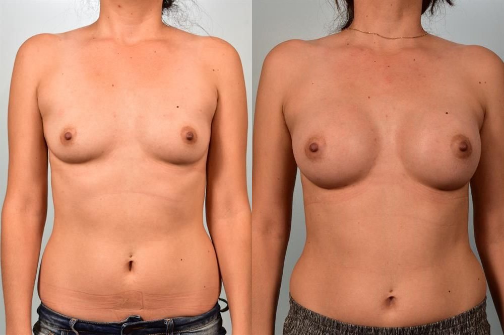 Breast Augmentation 140