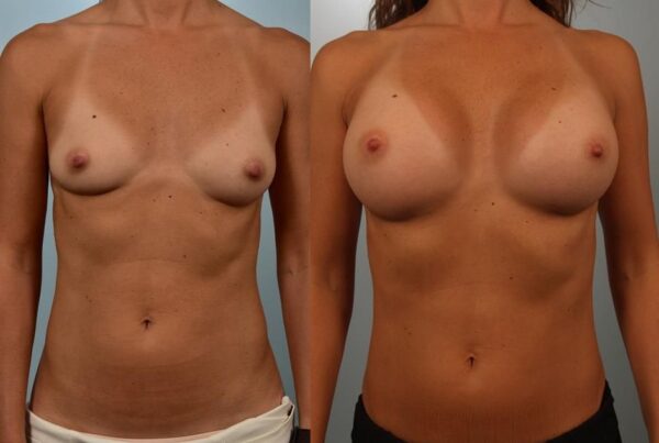 Breast Augmentation 141