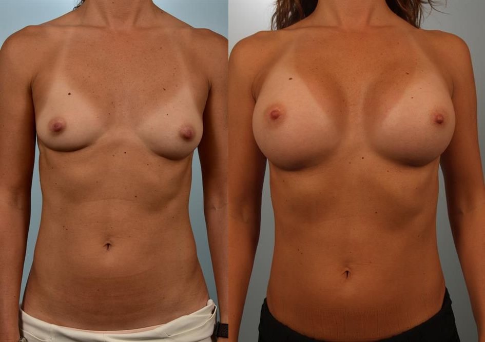 Breast Augmentation 141