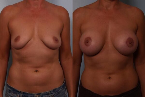 Breast Augmentation 142