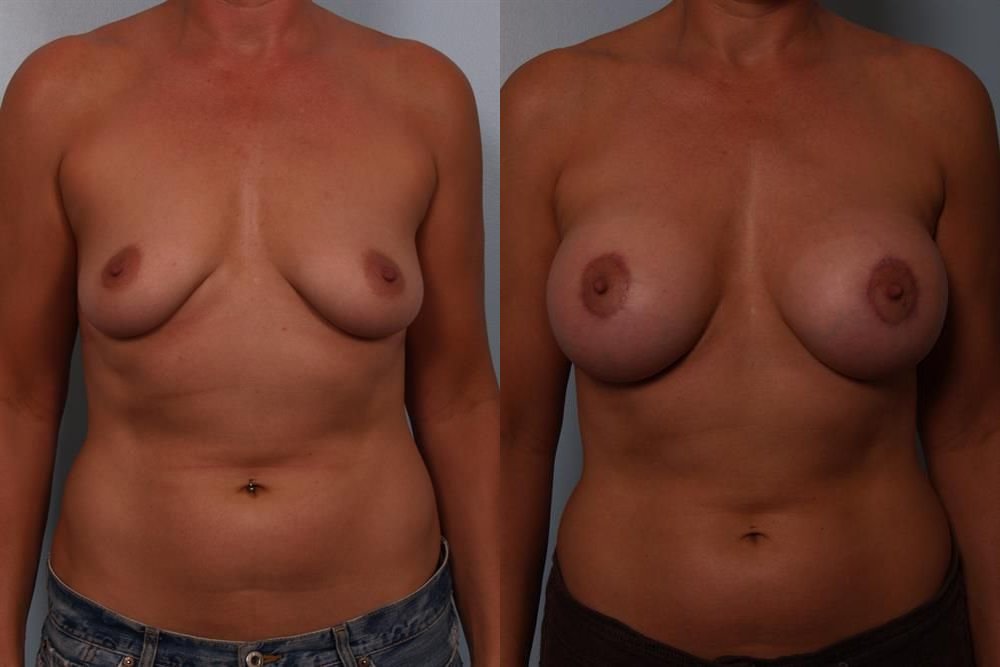 Breast Augmentation 142