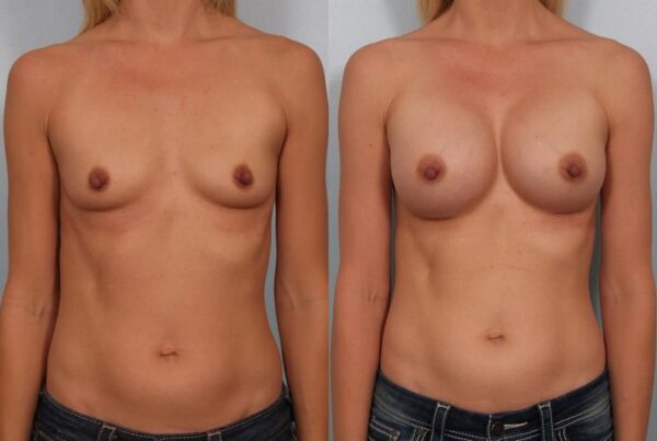 Breast Augmentation 143
