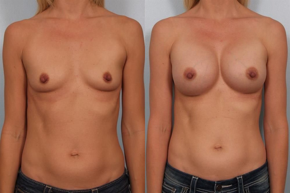 Breast Augmentation 143