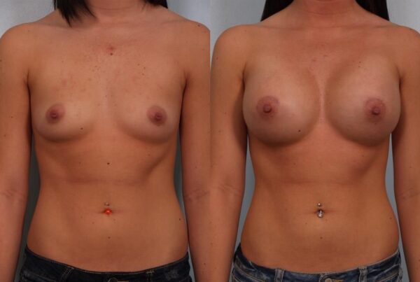 Breast Augmentation 144