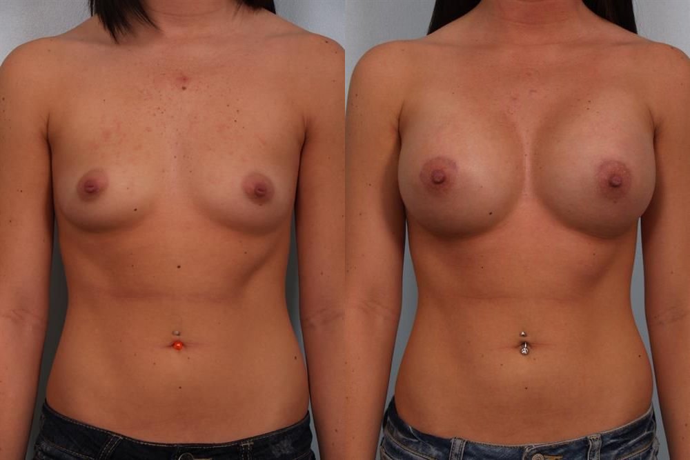Breast Augmentation 144