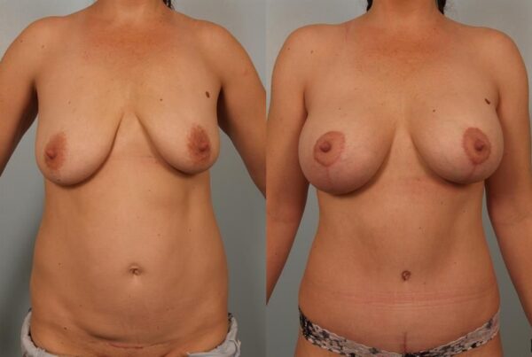 Breast Augmentation 146