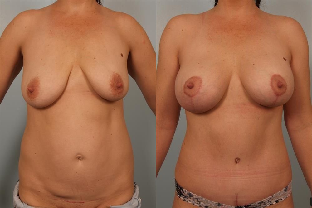Breast Augmentation 146