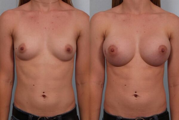 Breast Augmentation 147