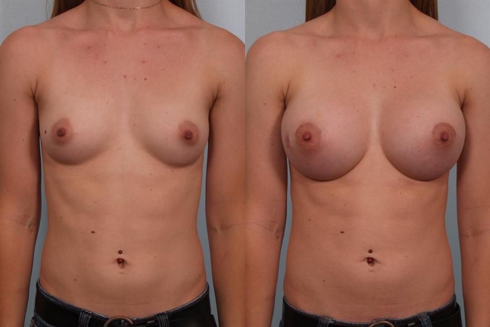 Breast Augmentation 147