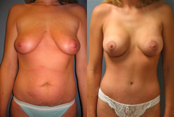 Breast Augmentation 148