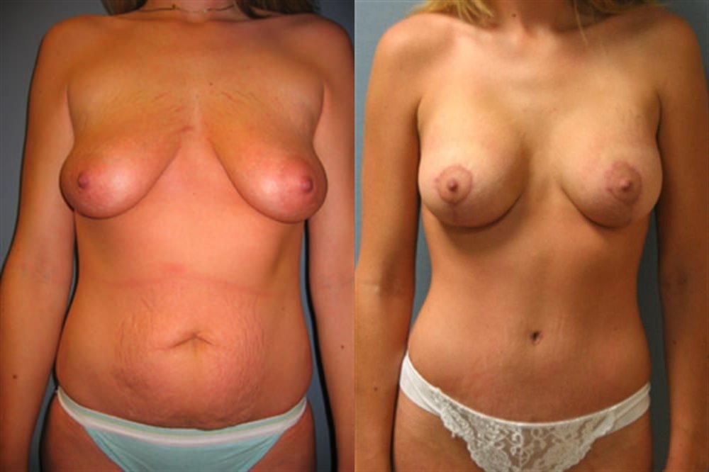 Breast Augmentation 148