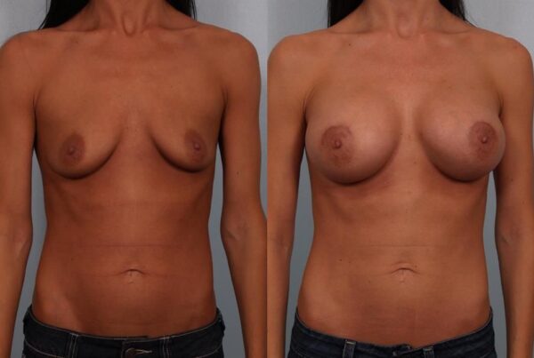 Breast Augmentation 149