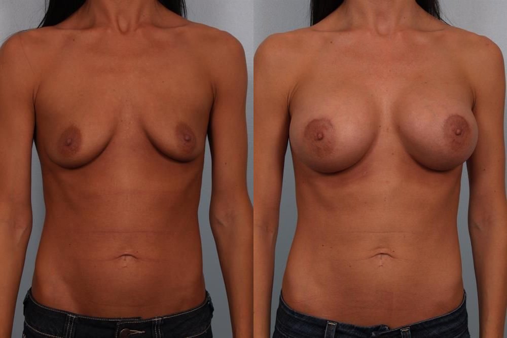 Breast Augmentation 149