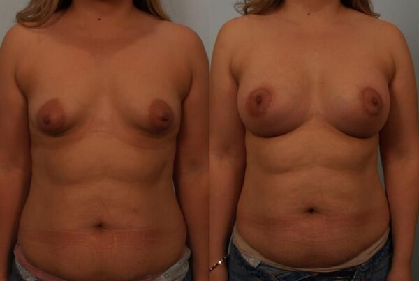Breast Augmentation 15
