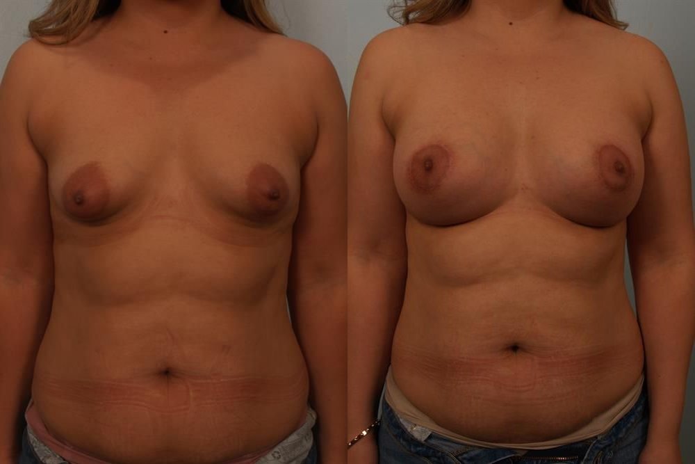 Breast Augmentation 15
