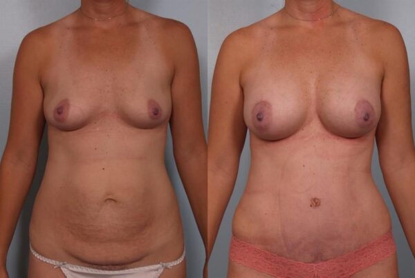 Breast Augmentation 150