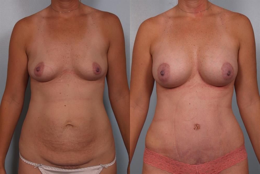 Breast Augmentation 150
