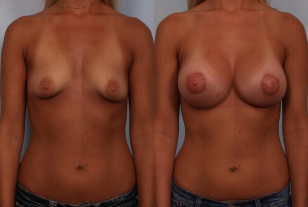 Breast Augmentation 151