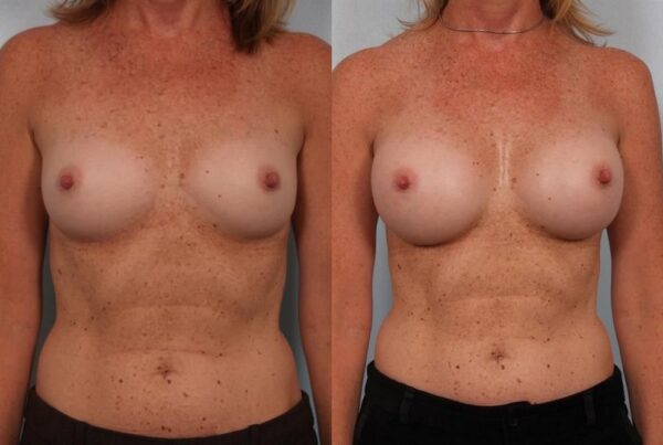 Breast Augmentation 152