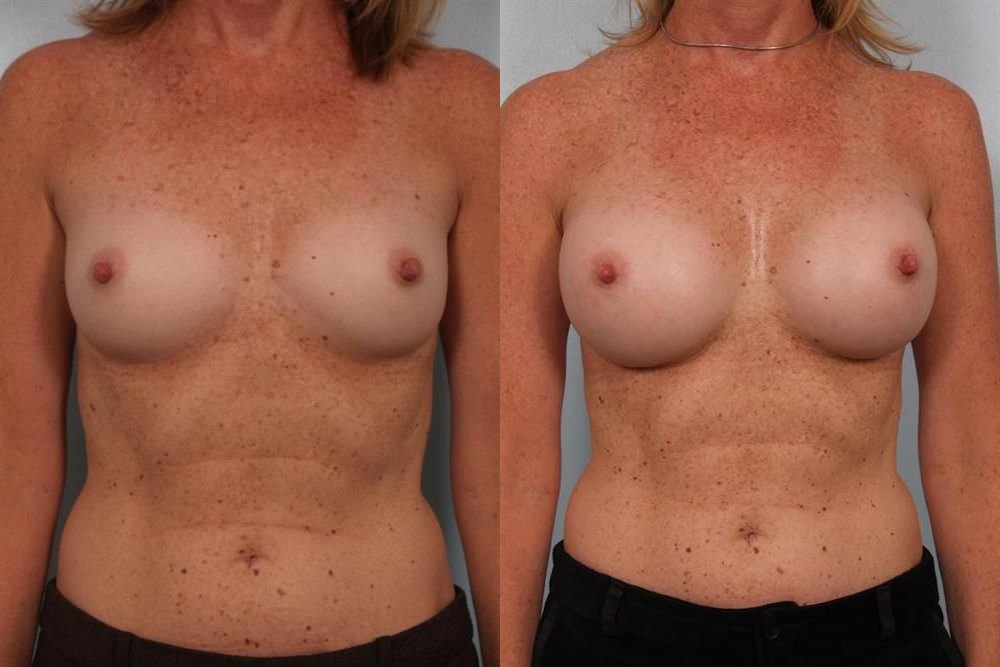 Breast Augmentation 152